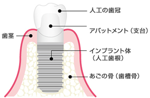 インプラントとは