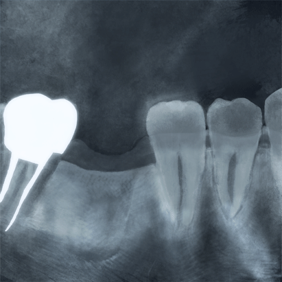 歯が抜けたレントゲン