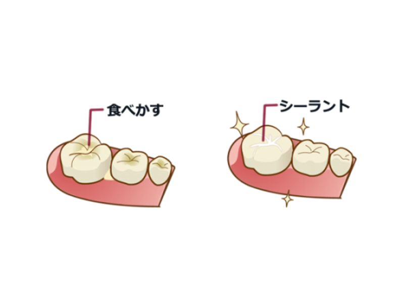 シーラント