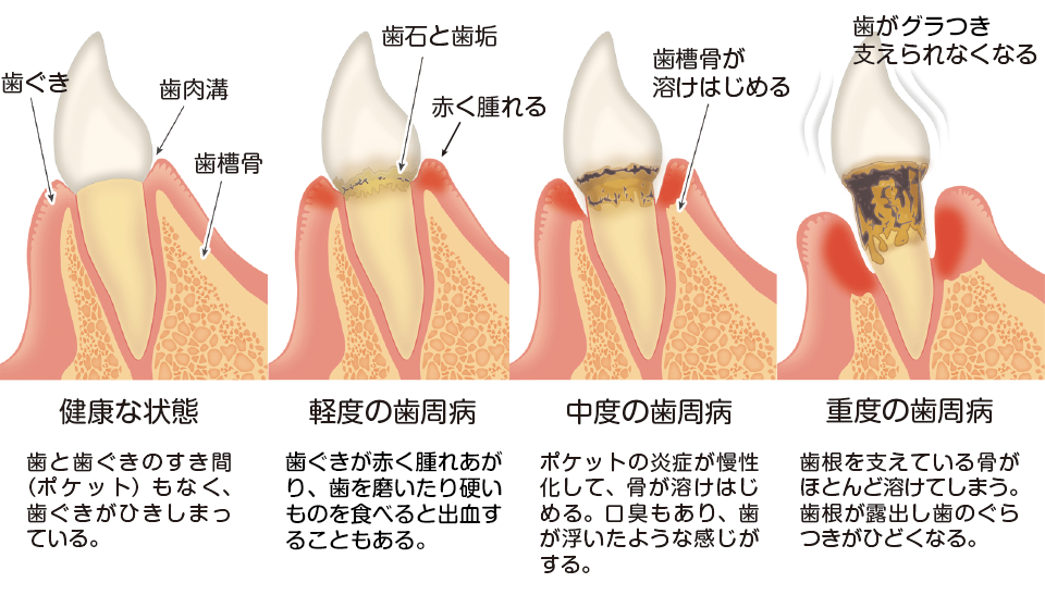 歯周病　流れ