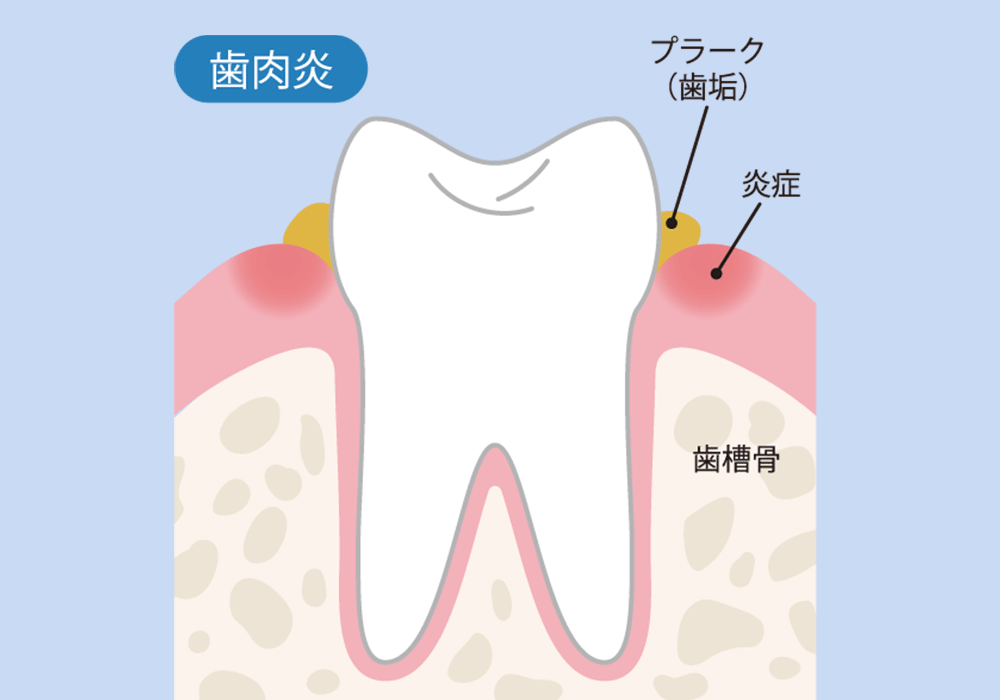 歯肉炎とは