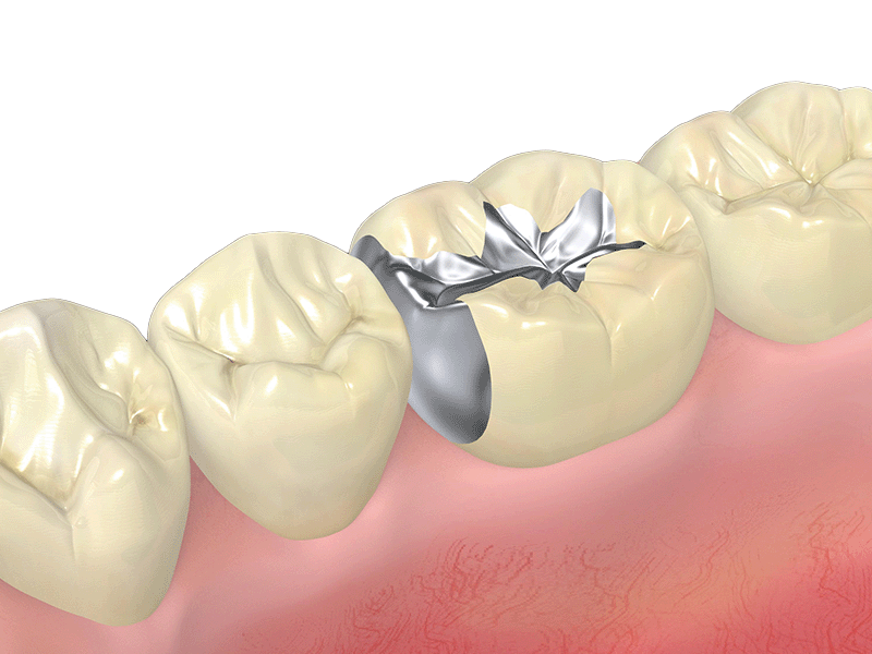 セラミック　インレー
