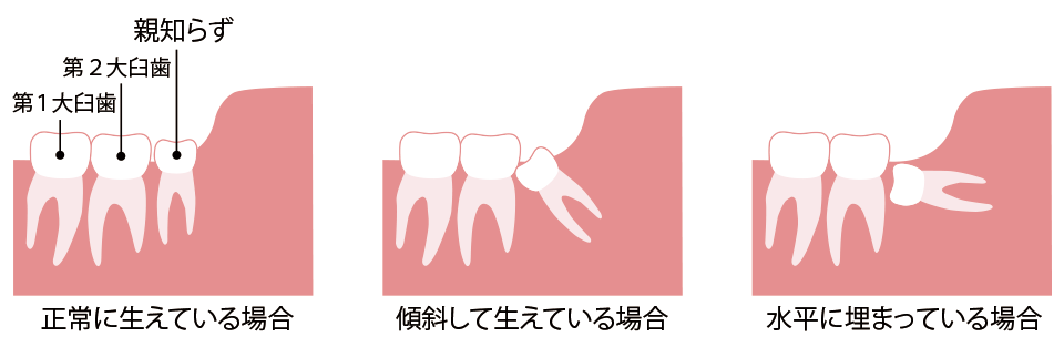 親知らずの生え方