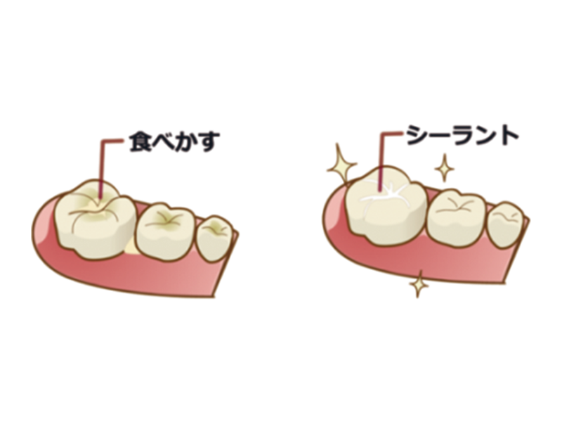 シーラント