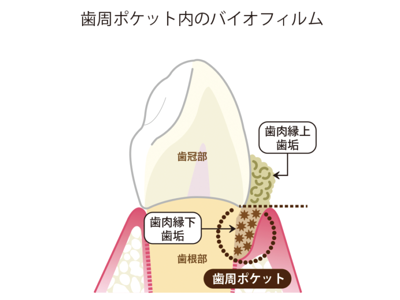 歯周ポケット