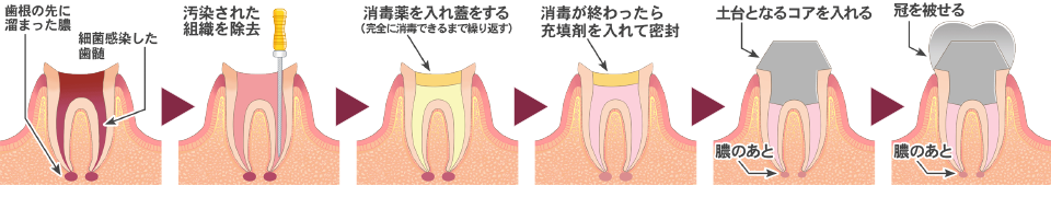 根幹治療過程