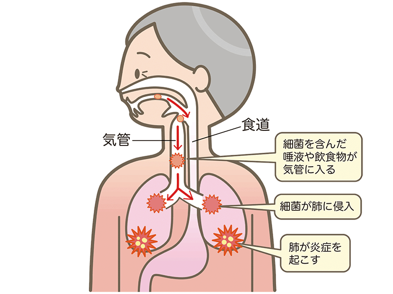 肺炎リスク