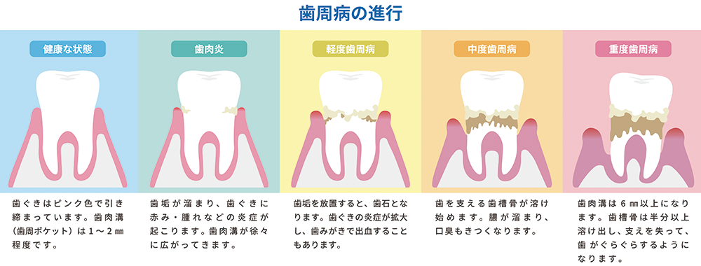 歯周病の進行